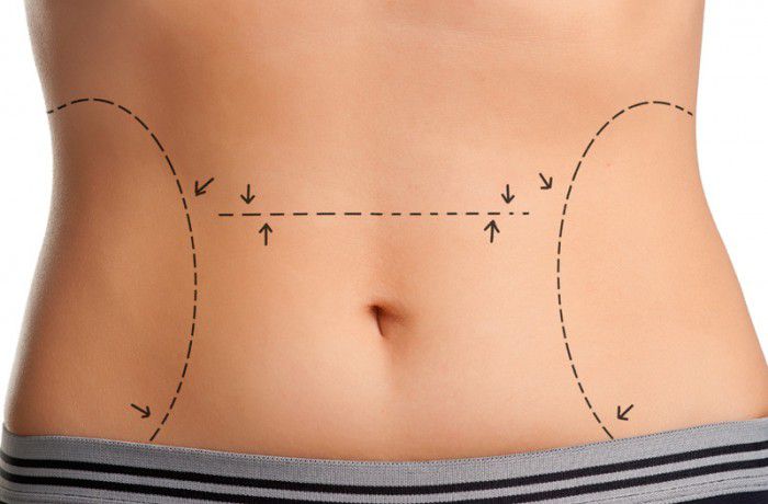 Абдоминопластика живота - эффективный способ коррекции недостатков