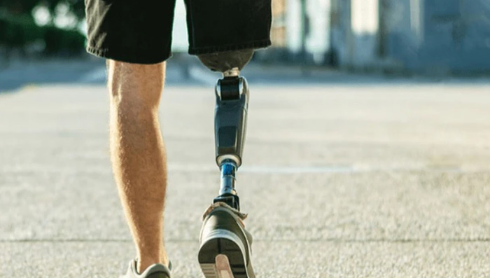 Чому сучасні протези стопи кращі за ті, що були 10 років тому?